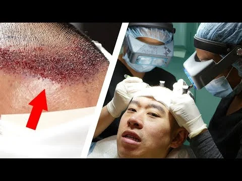 A Bald Man Gets a Hair Transplant